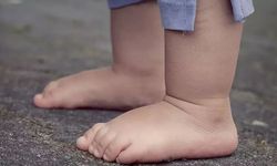 Çocuklarda Obezite Düztabanlık Nedeni!