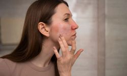 Soğuklarda Cilt Kuruluğuna Karşı 10 Tavsiye