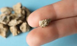 Böbrek Taşından Korunmak İçin 4 Önemli Öneri