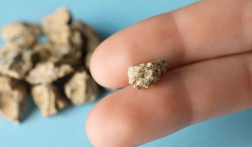 Böbrek Taşından Korunmak İçin 4 Önemli Öneri